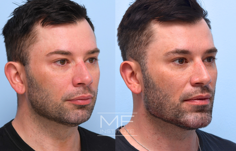 Before-and-after jawline filler results case #726