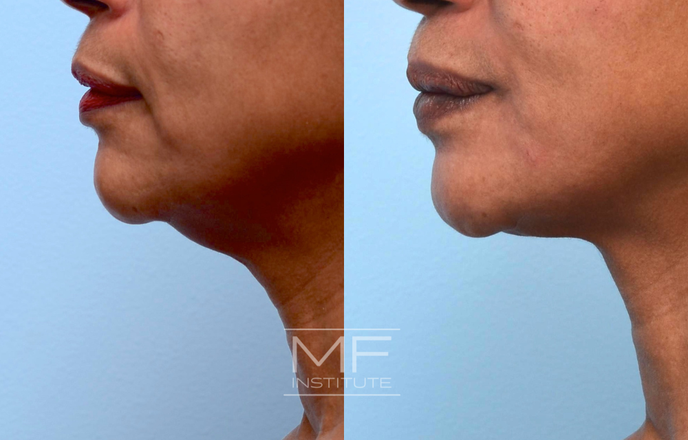 Before-and-after jawline results case #446