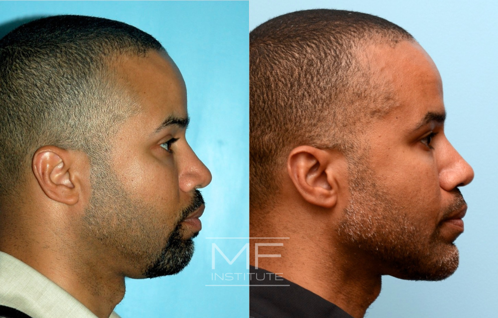 Before-and-after jawline results case #367