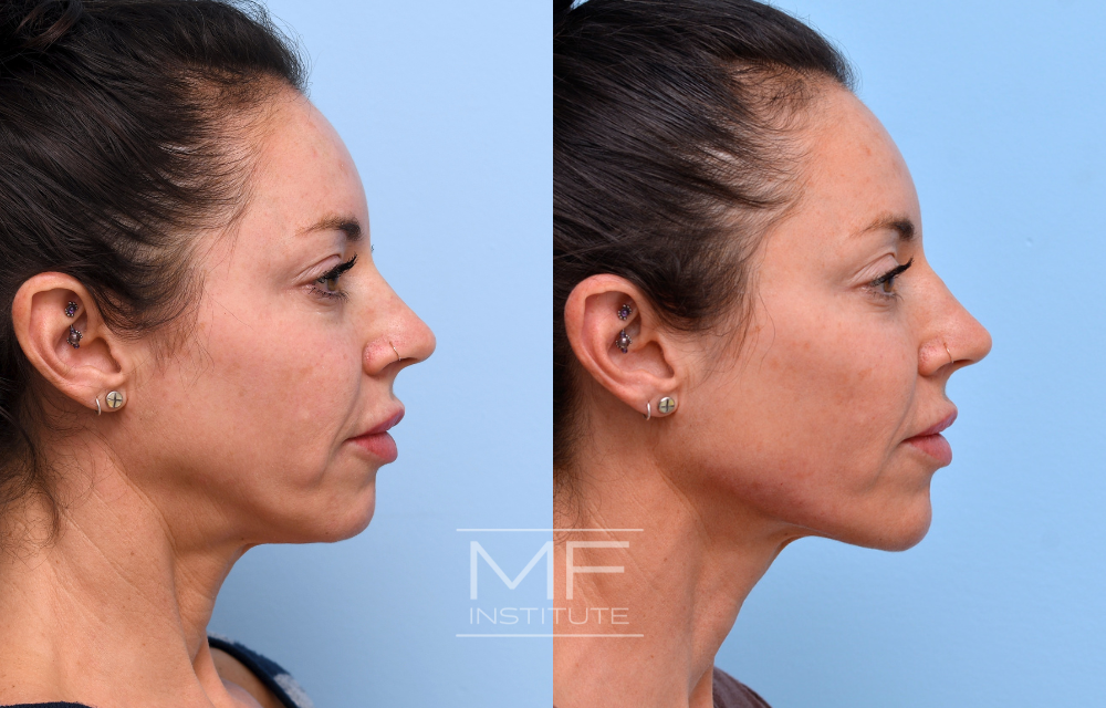 Before-and-after jawline results case #738