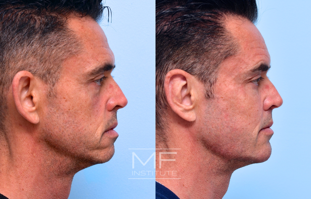Before-and-after jawline results case #645