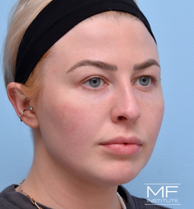 Woman after BOTOX Brow Lift treatment