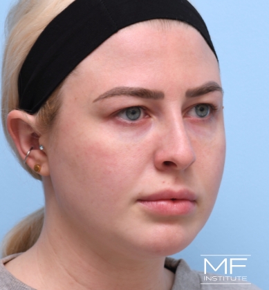 Woman before BOTOX Brow Lift treatment