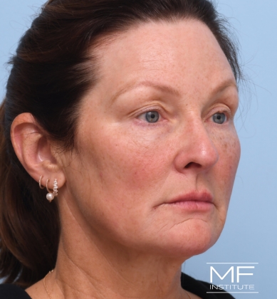 Woman after BOTOX Brow Lift treatment