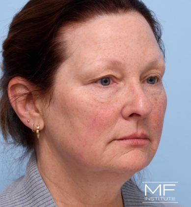 Woman before BOTOX Brow Lift treatment