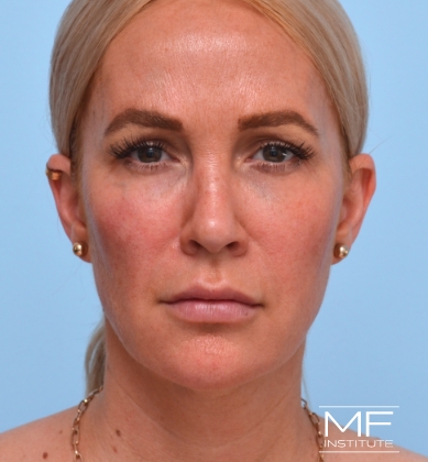 Woman's face after botox for the forehead and brow, plus bunny lines.