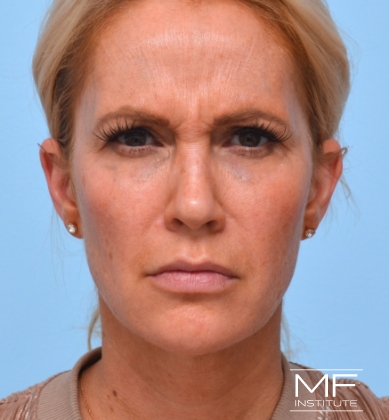 Woman's face before botox for the forehead and brow, plus bunny lines.