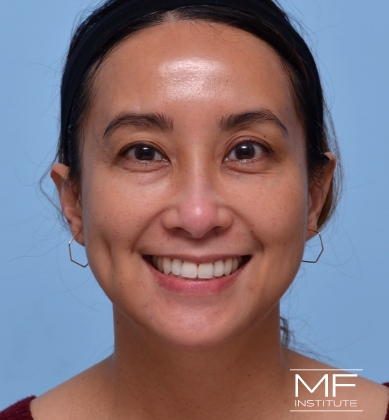 Woman after a BOTOX for Forehead & Brow treatment.