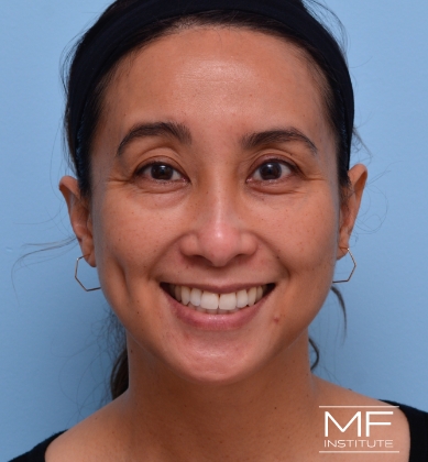 Woman before a BOTOX for Forehead & Brow treatment.