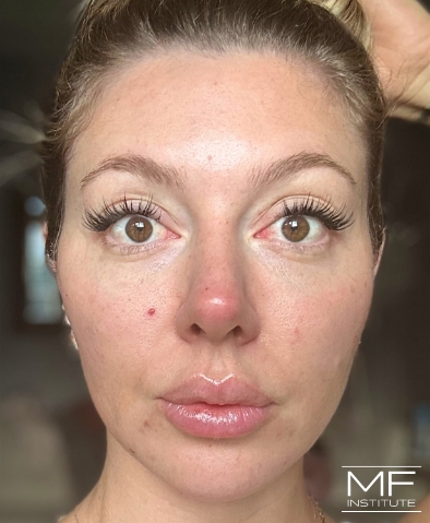 Woman two months after cheek filler treatment