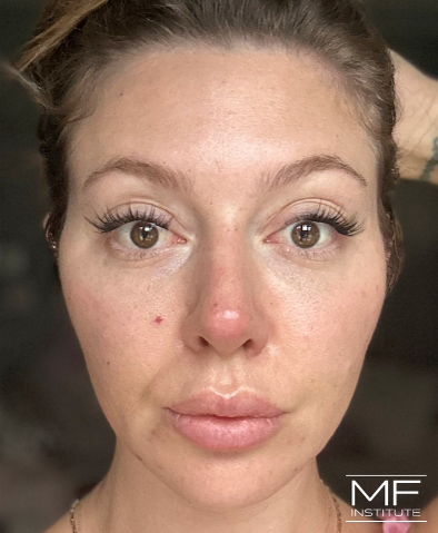 Woman immediately after cheek filler treatment