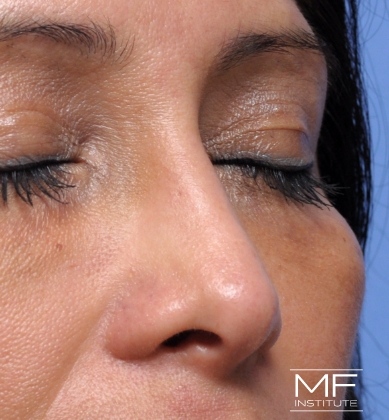 Woman after non-surgical rhinoplasty correction to restore nasal collapsed bridge.