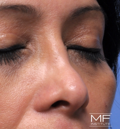 Woman before non-surgical rhinoplasty correction to restore nasal collapsed bridge.