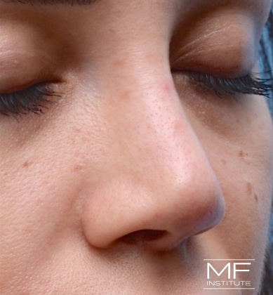 Woman after non-surgical rhinoplasty correction to address nasal collapsed tip.