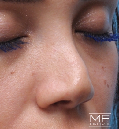 Woman before non-surgical rhinoplasty correction to address nasal collapsed tip.