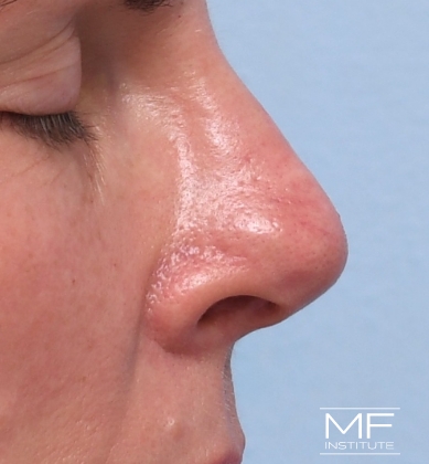 Woman after non-surgical rhinoplasty correction to address nasal tip contour irregularities.