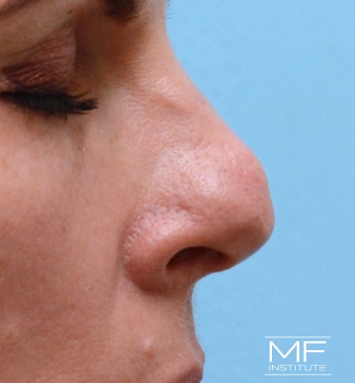 Woman before non-surgical rhinoplasty correction to address nasal tip contour irregularities.