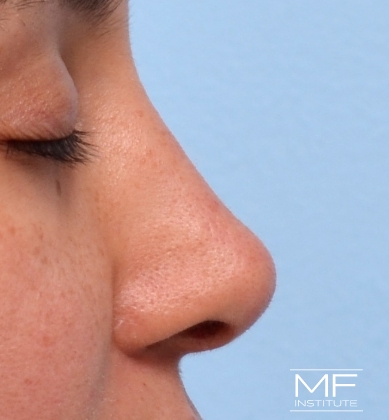 Woman after non-surgical rhinoplasty correction to nasal humps, lumps, and bumps.