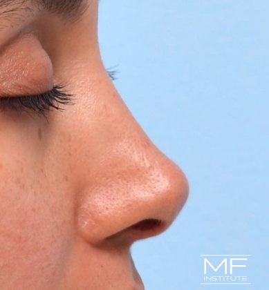 Woman before non-surgical rhinoplasty correction to nasal humps, lumps, and bumps.