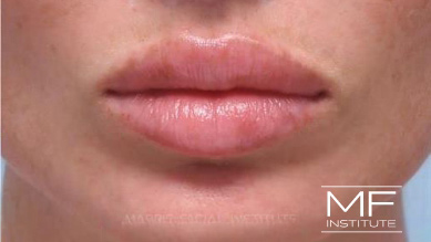 After dissolving lip filler on woman