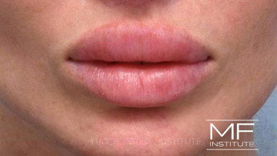 Before dissolving lip filler on woman