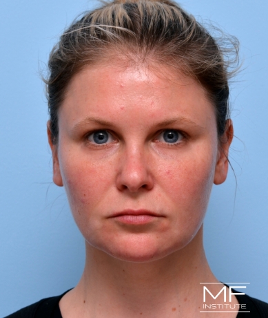 Woman after Facial Slimming With BOTOX, Cheek, Chin, & Jawline Filler