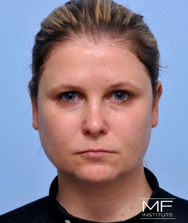 Woman before Facial Slimming With BOTOX, Cheek, Chin, & Jawline Filler