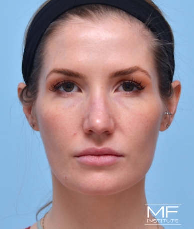 Woman after masseter botox treatment.