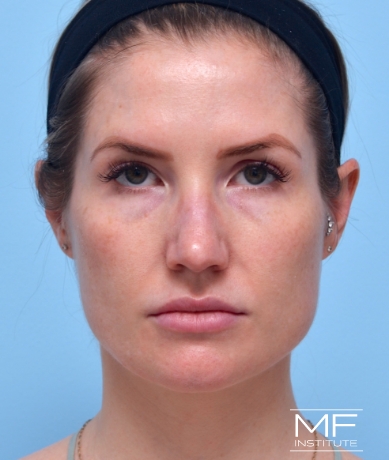 Woman before masseter botox treatment.