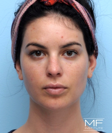 Woman after Facial Slimming With Dysport, Cheek, & Chin Filler.