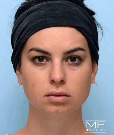 Woman before Facial Slimming With Dysport, Cheek, & Chin Filler.