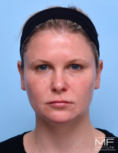 Woman after two of two facial slimming treatments