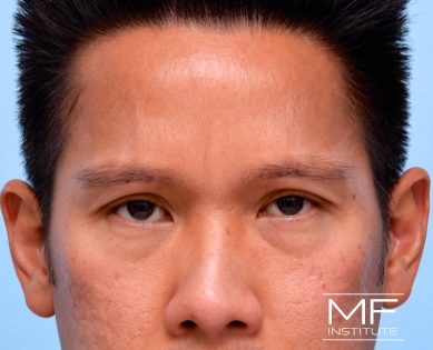 Man after forehead and brow BOTOX treatment