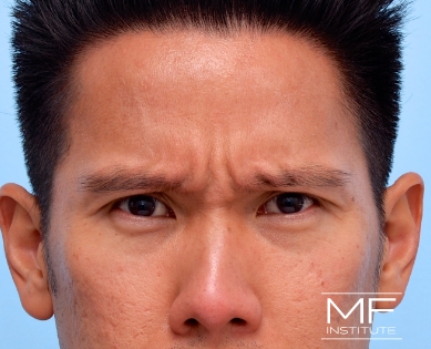 Man before forehead and brow BOTOX treatment