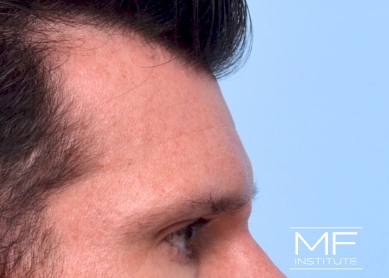 Man after forehead filler treatment