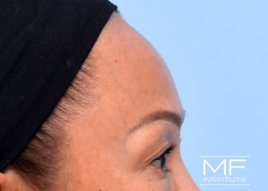 Woman after forehead filler treatment