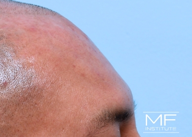 Man after forehead filler treatment