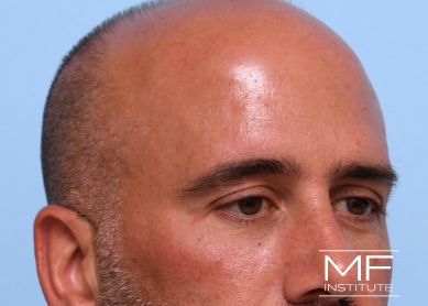 Man after forehead filler treatment