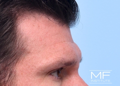 Man before forehead filler treatment