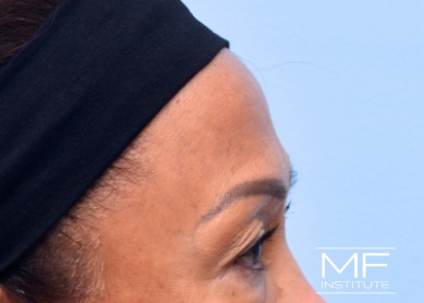 Woman before forehead filler treatment