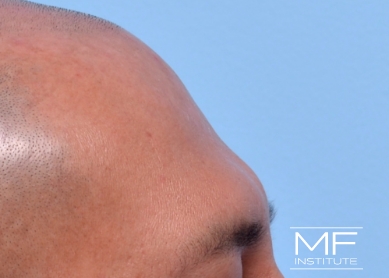 Man before forehead filler treatment