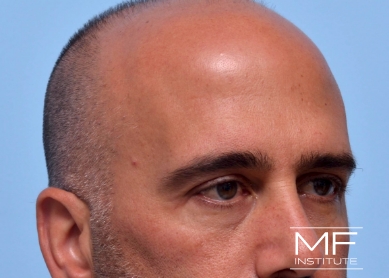 Man before forehead filler treatment