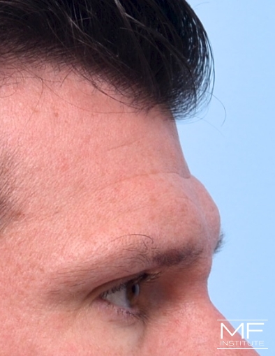 Man before forehead filler treatment