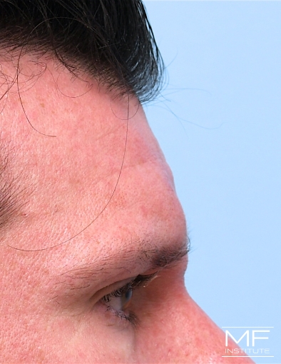 Man after one forehead filler treatment