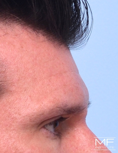 Man after two forehead filler treatments