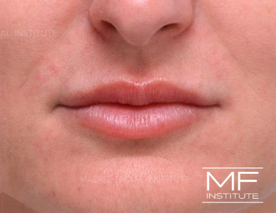 Close up of a woman's lips, after the Bold and Beautiful Lip Filler treatment.