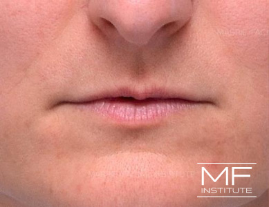 Close up of a woman's lips, before the Bold and Beautiful Lip Filler treatment.