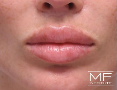 Close up of a woman's lips, after the correction of a previous Lip Filler treatment.