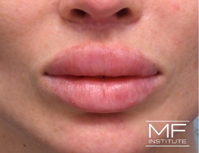 Close up of a woman's lips, before the correction of a previous Lip Filler treatment.