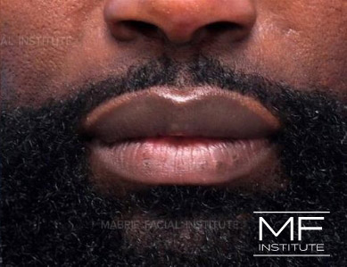 Close up of a man's lips, after Lip Filler treatment for smoothness and definition.